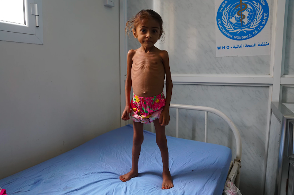 Yemen Child Trauma 6