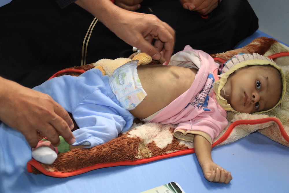 Yemen Malnutrition 4